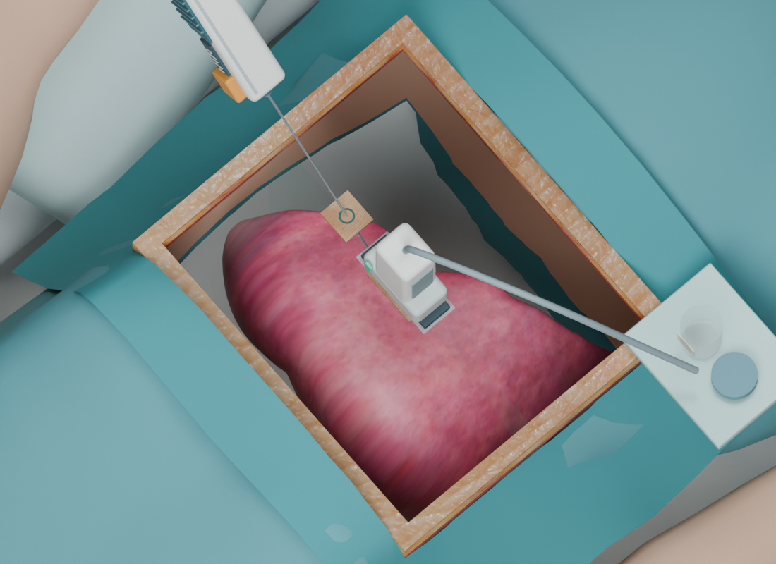 Liver biopsy teaching scene with a patient, ultrasound probe and biopsy needle